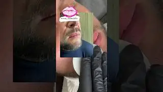 Мужские губы , до/после 