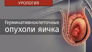 ДЕМО Герминативноклеточные опухоли яичек | Лекции по патологической анатомии