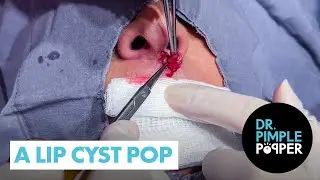 A Lip Cyst Pop