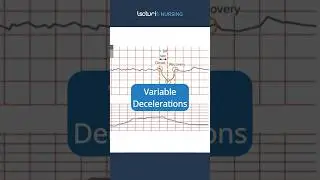 Variable Decelerations Uncovered 🩺 #NursingStudents #FetalMonitoring