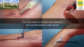 Treatment for Varicose Veins Procedures  (Hindi) - CIMS Hospital