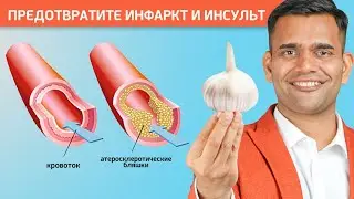 ИНФАРКТ И ИНСУЛЬТ. Профилактика.