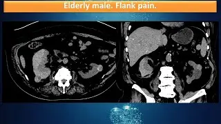 Elderly male. Flank pain.