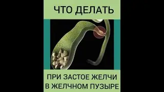 Застой желчи - билиарный сладж в желчном пузыре. Прчины, симптомы, диагностика и лечение