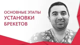 Этапы установки брекетов. 😊 Этапы установки брекетов и другие методы исправления прикуса. 12+