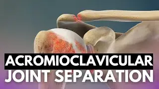 Acromioclavicular Joint Separation: Navigating Symptoms and Treatment