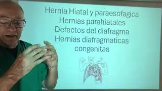 Hernia hiatal y paraesofágica. Hernias congénitas  de Hiss Boshdaleck y larrey  Morgagni