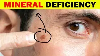 #1 Mineral To Remove Age Spots In People Over 50