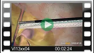 DynaMesh®-ENDOLAP 3D - Animation: TAPP Technique for Treatment of Inguinal Hernia