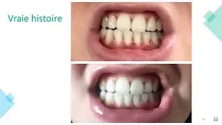 AP24 - Blanchiment des dents - Sans peroxyde !
