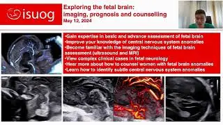 Prof. Francesco D'Antonio on ISUOG course, Exploring the Fetal Brain