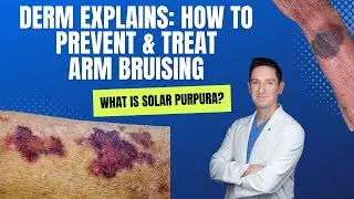 Dermatologist explains Solar Purpura (Purple Bruising on the Arms): How can you PREVENT & TREAT IT?