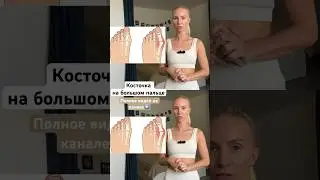 Как убрать косточку на большом пальце? Смотри видео на канале▶️ #спорт #осанка #вальгус #косточка