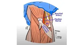 Lacertus Syndrome