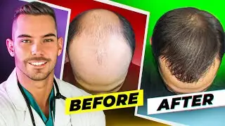 The Ultimate Guide To Prevent & Reverse Hair Loss In Men (Without Finasteride)