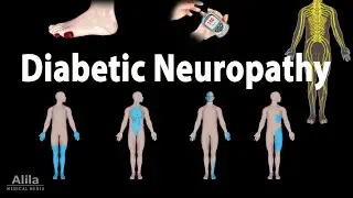 Diabetic Neuropathy, Animation