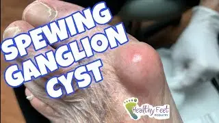 Spewing Ganglion Cyst