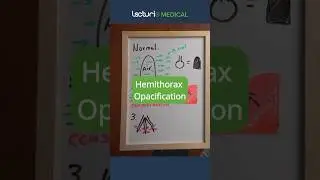 Hemithorax Opacification on X-ray: Key Facts 🩺 #ChestXray #Radiology #USMLE