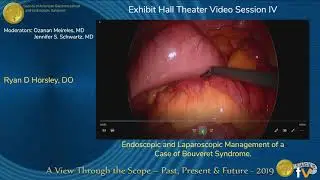 Endoscopic and Laparoscopic Management of a Case of Bouveret Syndrome