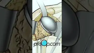 PreOp® What to Expect: Open Shoulder Replacement! 🔍 #preop #shorts #health 🏥