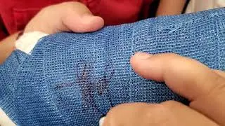 Signing My First Autograph On Cast In A Long Time