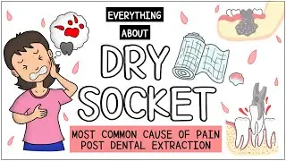 Dry Socket (After tooth extraction): All you need to know