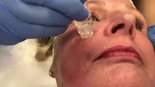 The YPS Gold FillTox Facial! - Dr.  Anthony Youn