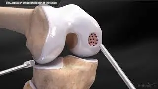 BioCartilage® Allograft Repair of the Knee