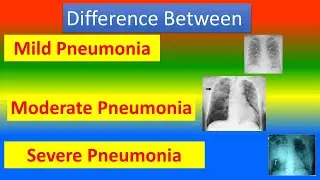 Difference Between Mild, Moderate and Severe Pneumonia