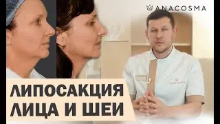 ЛИПОСАКЦИЯ ЛИЦА, ЩЕК, ВТОРОГО ПОДБОРОДКА 🔥  КОГДА МОЖНО, А КОГДА - НЕТ❓ПРОКОЛЫ☝🏻РЕАБИЛИТАЦИЯ