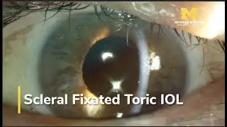 Scleral Fixated Toric IOL | Dr. Nallasamy