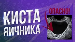 ОПАСНО! КИСТА ЯИЧНИКА! Чем грозит если не лечить?