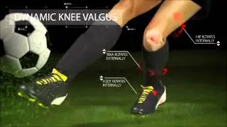 Anterior Cruciate Ligament (ACL) Injury