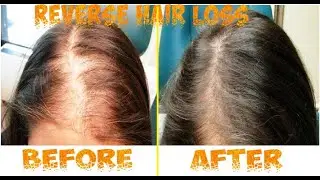 How I STOPPED MY HAIR LOSS! №1 Thing That Re Grew My Hair! #hair