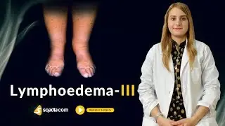 Lymphoedema -III | Surgery Video Lectures | Medical Student Online Education | V-Learning