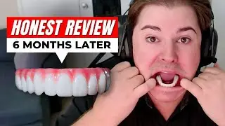I Wish I Knew THESE Struggles Before Getting Dental Implants…