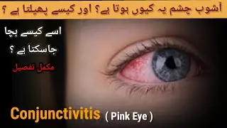 Ashob E Chashm ka ilaj | Eye infection | Conjunctivitis |