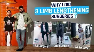 SEDAT: WHY I DID 3 LIMB LENGTHENING SURGERIES?