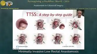 Minimally Invasive Low Rectal Anastomosis