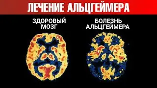 Что провоцирует болезнь Альцгеймера? Революционное открытие🧠