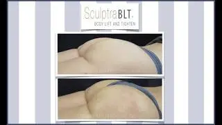 InjectAble Butt Lift