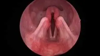 Dog: Lar Par (Laryngeal paralysis observed in sedated canine oral exam)