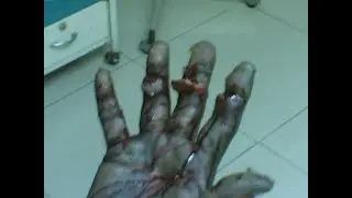 Incident News   Hand and Finger Injury