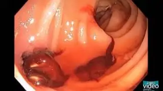 Aortoenteric Fistula