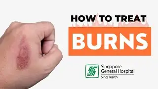 How to Treat Burns | MY DOCTOR'S ADVICE!