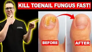 #1 BEST Toenail Fungus Treatment? [Top 10 Home Remedies] 2024