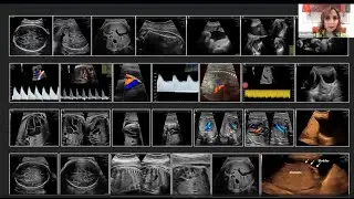 New ISUOG Practice Guidelines: The performance of a third-trimester obstetric ultrasound scan