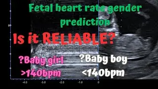 Ultrasound fetal heart rate gender prediction. Is it reliable? How accurate is it? Three Cases