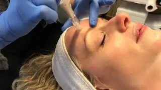 Microneedling - Non-Invasive Skin Care Treatment - Dr. Anthony Youn