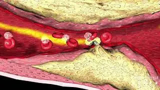 3D Medical Animation | Myocardial Infarction Thrombosis